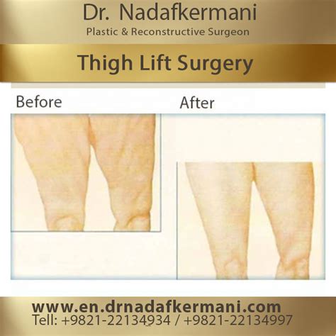 whats a thigh job|Thigh Lift (Thighplasty): Types, Surgery, Recovery & Scars